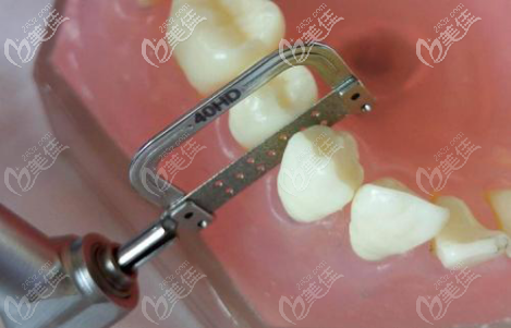 地包天矯正手術(shù)偏切牙齒的樣子