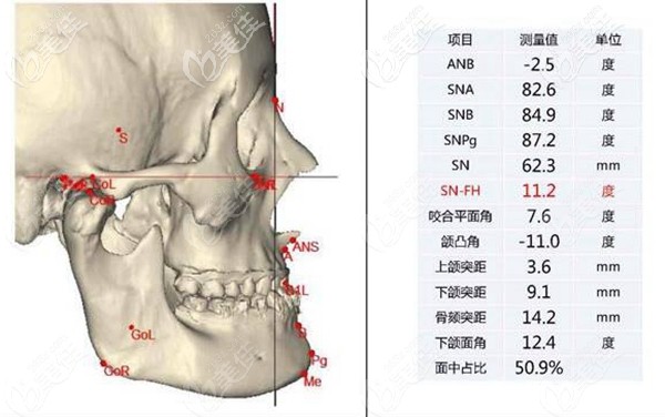 李運(yùn)峰DPS輪廓整形術(shù)