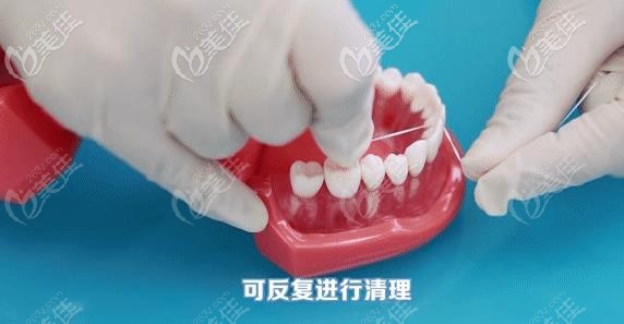 可以反復(fù)進(jìn)行清理