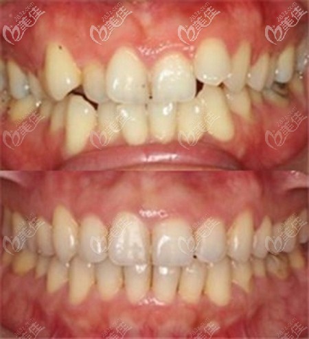 時代天使加強版矯正牙齒的效果對比