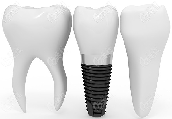 瑞典Astra種植系統(tǒng)