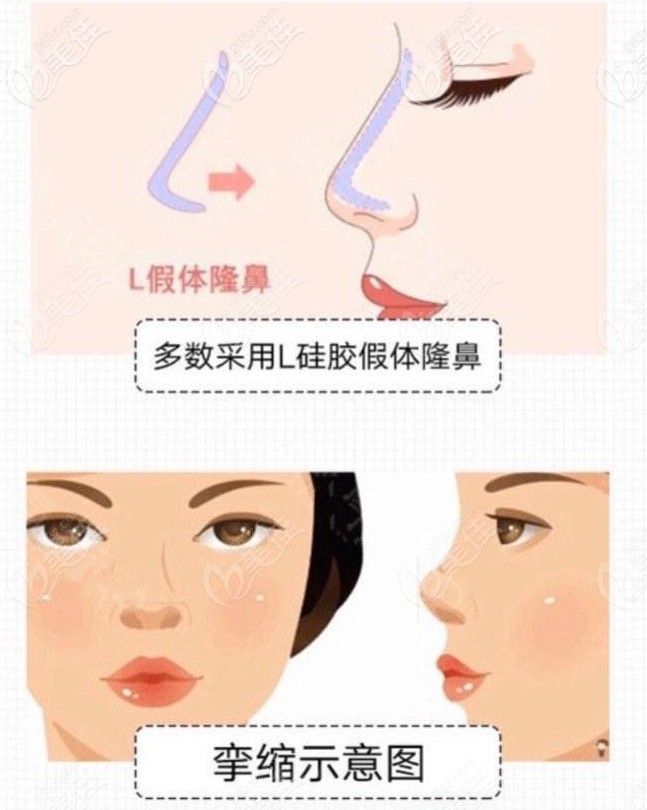 攣縮鼻失敗癥狀