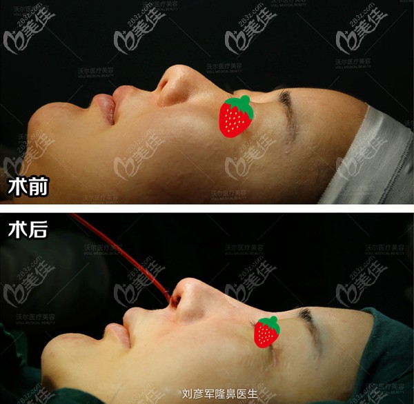 劉彥軍攣縮鼻修復(fù)案例