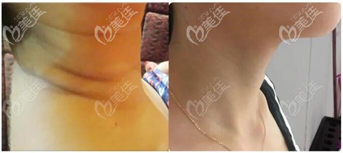 小針自體修復(fù)頸紋案例