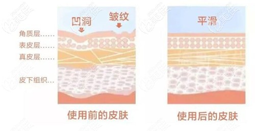 小針自體修復(fù)抗衰原理