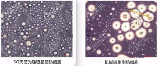 5G天使光雕吸脂活性高 5G天使光雕吸脂活性高