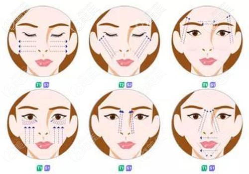 埋線提升的好處