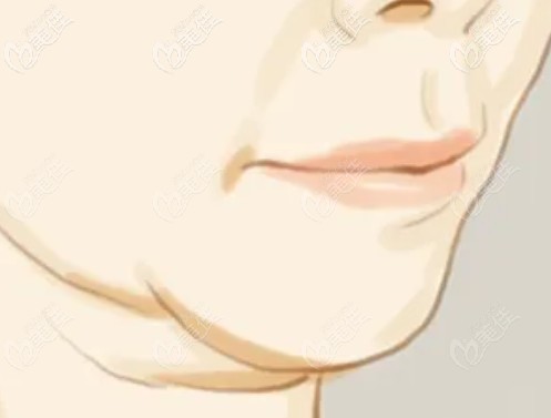 蘭州時(shí)光相伴做雙下巴抽脂 蘭州時(shí)光相伴做雙下巴抽脂