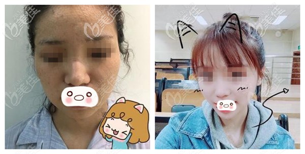 蘭州夢(mèng)想雙下巴抽脂圖片