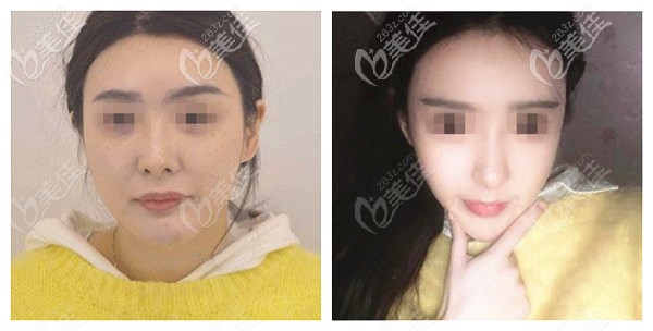 蘭州仁和整形雙下巴抽脂<span style= 蘭州仁和整形雙下巴抽脂<span style=