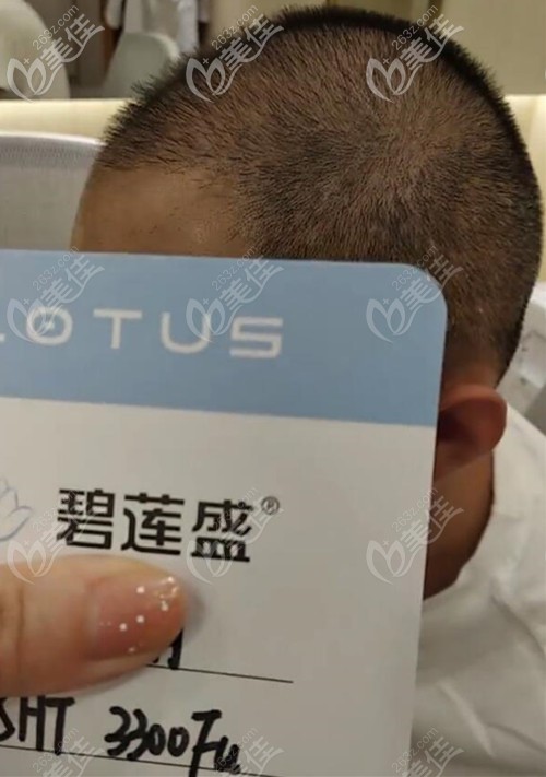 SHT植發(fā)3300毛囊單位術(shù)后2個(gè)月效果