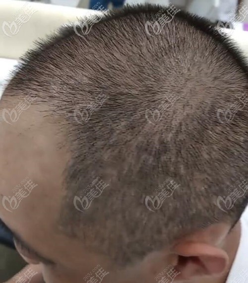 植發(fā)?靠譜實(shí)錘來了！展示下SHT技術(shù)植發(fā)3300單位2個(gè)月后的效果圖