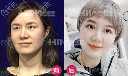 雅美全層灌注·雙倍提拉技術(shù)真人案例照