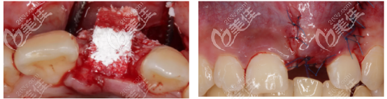 植入骨粉的樣子