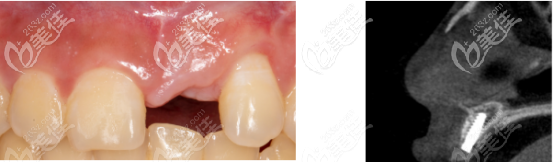 確認骨量沒有吸收的ct片子