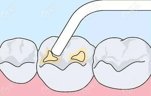 寶媽們需對(duì)窩溝封閉的注意事項(xiàng)注意啦