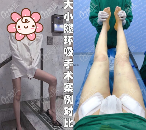 5G天使光雕大腿吸脂效果圖 5G天使光雕大腿吸脂效果圖