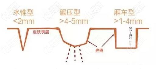 凹洞性痘坑類(lèi)型圖片