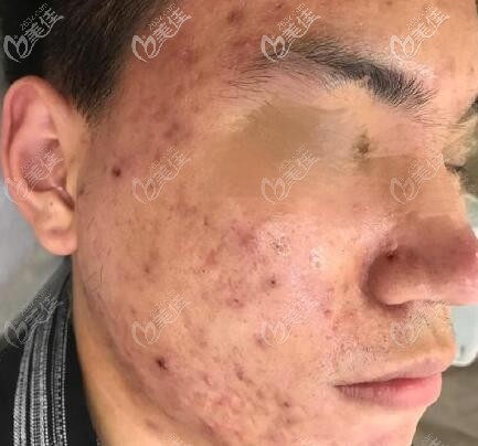 座瘡增生性凸起疤痕圖片