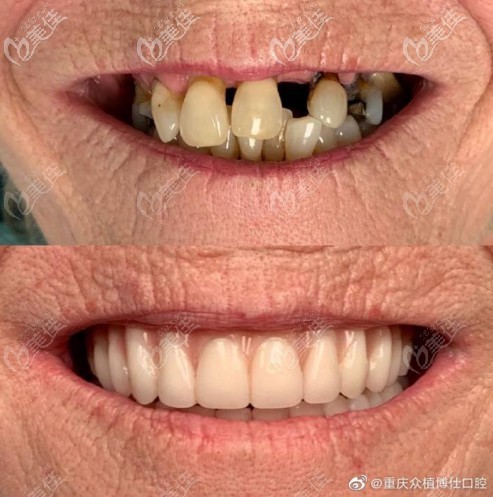 80歲老人在重慶眾植博仕口腔做allon4全口種植牙，當(dāng)天種牙當(dāng)天戴牙冠