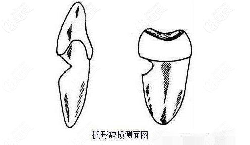 楔狀缺損側(cè)面圖
