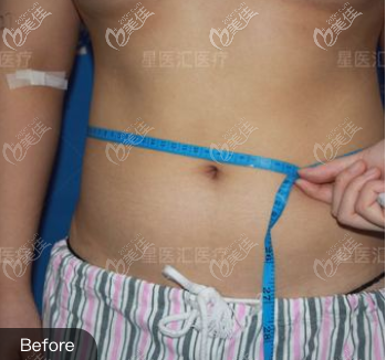 北京如朵醫(yī)療美容門診部季一發(fā)術(shù)前照片1