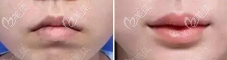 嘴角上揚術(shù)前術(shù)后對比照