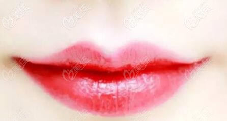 嘴角上揚術(shù)內(nèi)切效果如何，后期會不會反彈