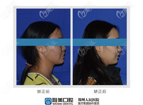 骨性齙牙內(nèi)收3mm效果 骨性齙牙內(nèi)收3mm效果