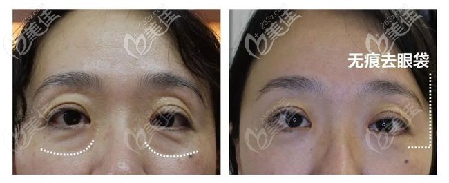 Fotona4d去眼袋前后對比