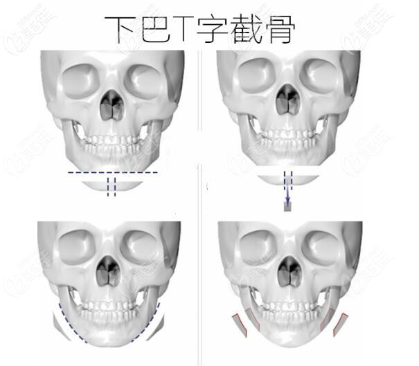 下巴t型截骨手術圖解