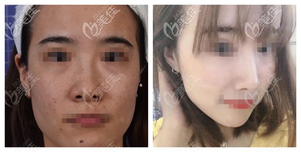 fotona  4D PRO除皺美白效果