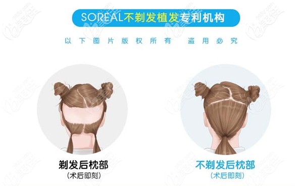 首瑞不剃發(fā)種植專屬機構(gòu)