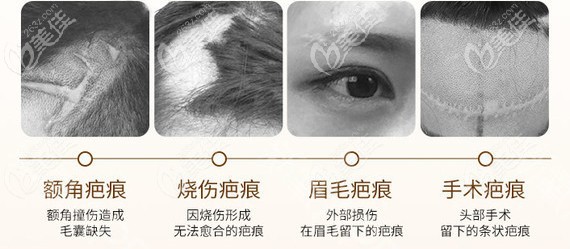 燒傷、燙傷、刀疤疤痕可以植發(fā)嗎