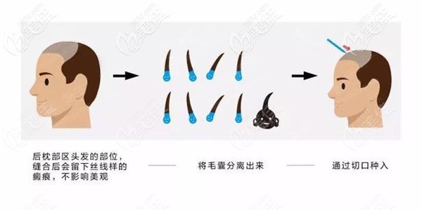 疤痕植發(fā)手術(shù)原理示意圖