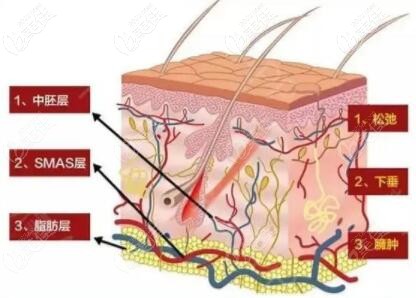 熱拉提作用的皮膚層 熱拉提作用的皮膚層
