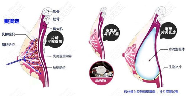 奧美定取出后要定制版3D智能基因生物補(bǔ)片修補(bǔ)缺損部位