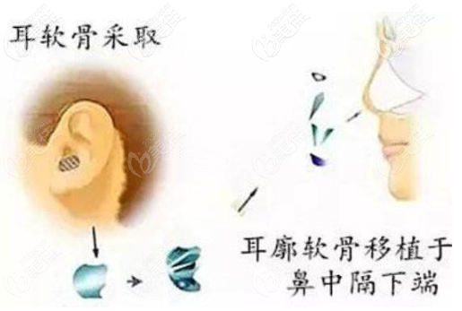 取耳軟骨的部位