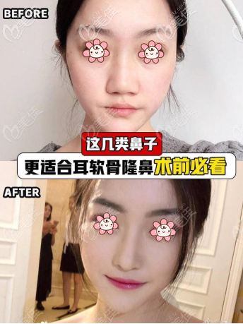 雙側(cè)耳軟骨隆鼻效果圖