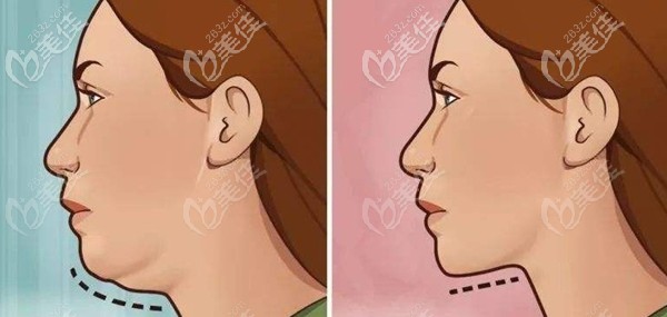 熱拉提對雙下巴的效果