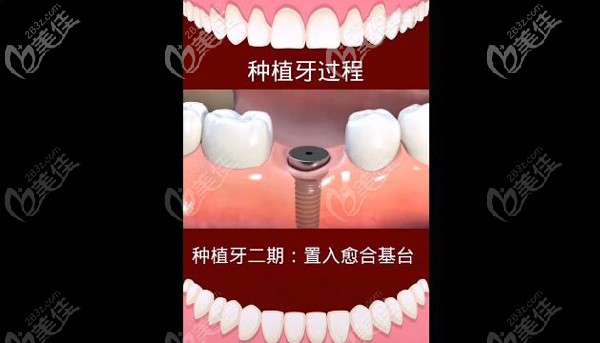 種植牙二期手術(shù)
