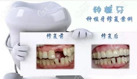 ?？谖⑿谇环N植牙真人對比照