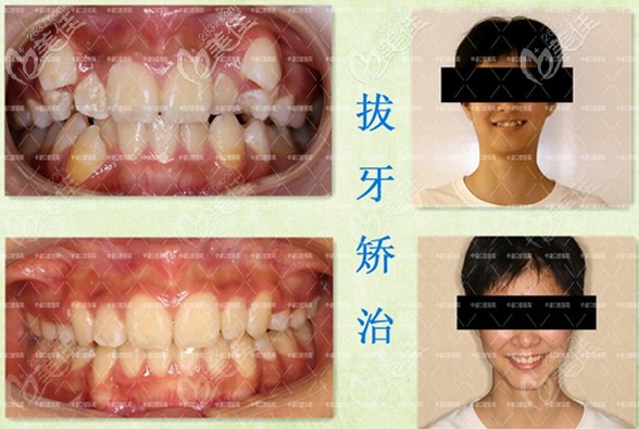 一口亂牙，在石家莊中諾做了拔牙矯正，用的是隱適美隱形牙套