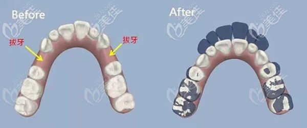 矯正牙齒前必要時還得拔牙 矯正牙齒前必要時還得拔牙