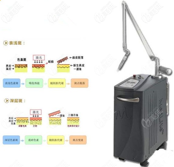 C6激光祛斑效果不錯