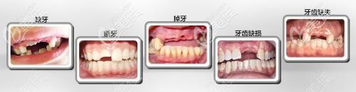 牙齒缺失的多種情況