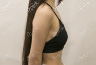 術(shù)前胸部側(cè)面照 術(shù)前胸部側(cè)面照