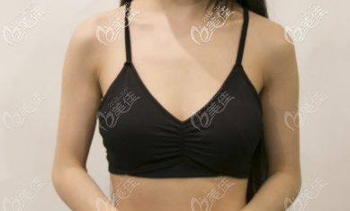 術(shù)前胸部正面照 術(shù)前胸部正面照