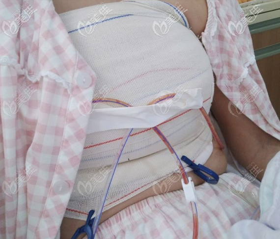 導(dǎo)流管 導(dǎo)流管