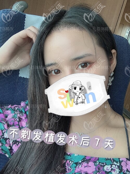 首瑞不剃發(fā)植發(fā)術(shù)后7天